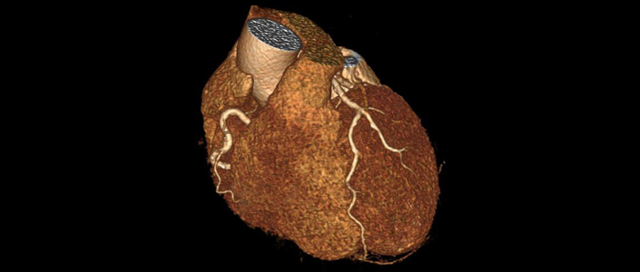 一項硬科技，讓CTA冠脈診斷方式徹底顛覆
